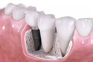 Implantes Dentales Dr. Castor