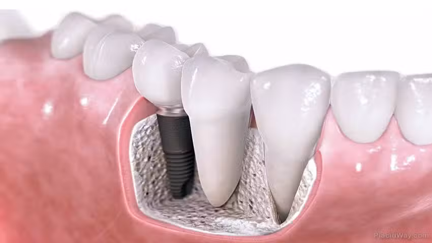 Implantes Dentales Dr. Castor