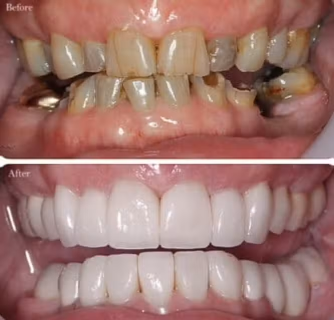 Implantes dentales en Parana Entre Rios Dr. Francisco Cuminetti