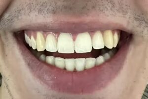 Implantes Dentales ~Est&eacute;tica Dra. Silvia P&eacute;rez Mulki