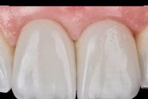 IMPLANTES DENTALES.ODONTOLOGIA DIGITAL DRA. SOLANGE ALVAREZ